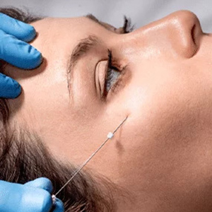 Fils crantés résorbables