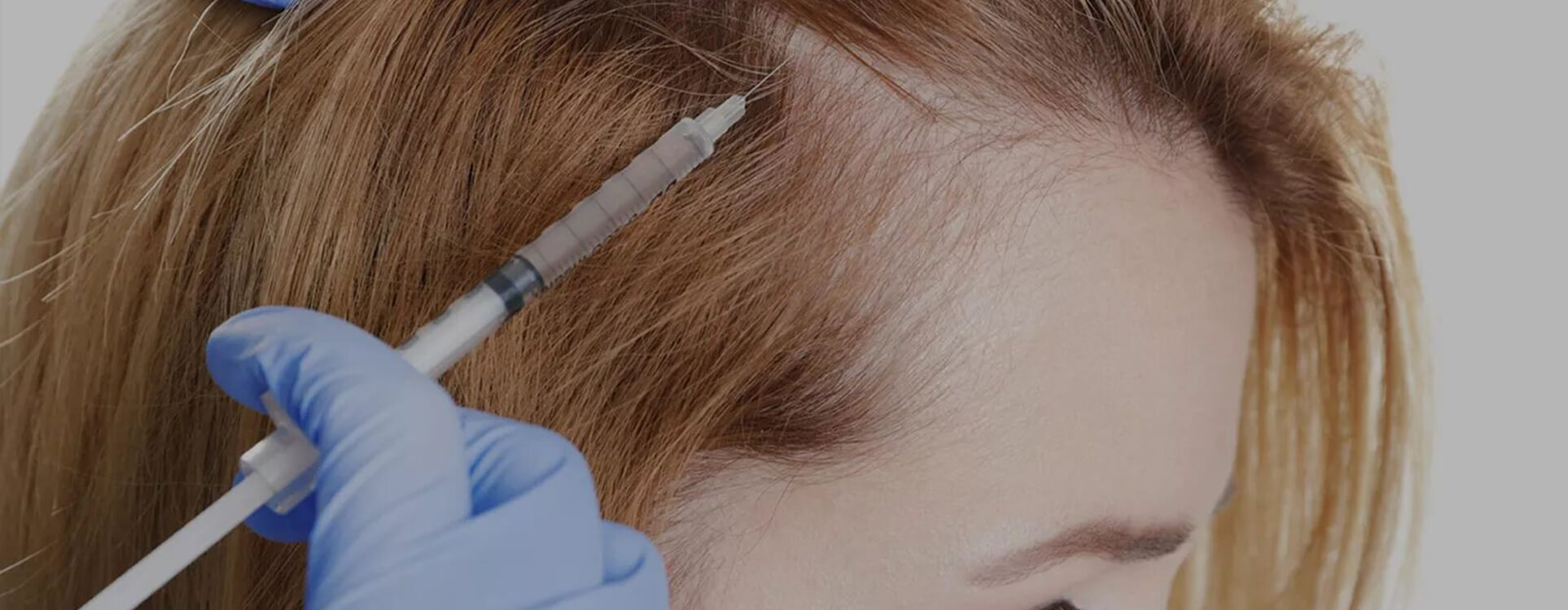 Mésothérapie cheveux et cuir chevelu