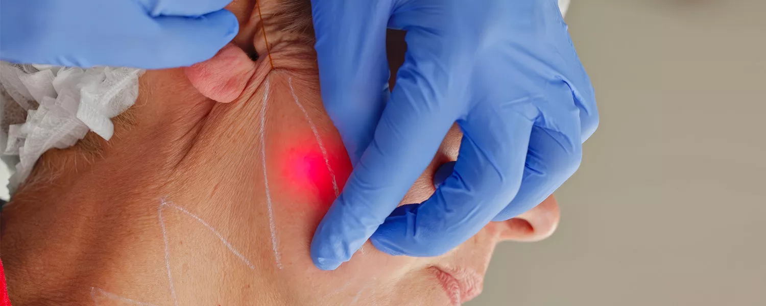 Blépharoplastie sans chirurgie