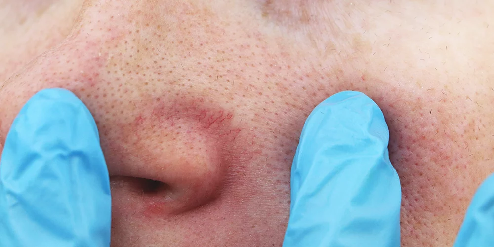 Definition-anomalies-vasculaires