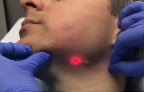 La-fibre-optique-inseree-dans-la-zone-a-traiter