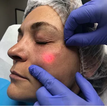 La-fibre-optique-inseree-sous-la-peau