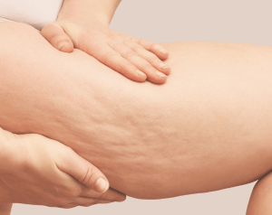 Cellulite_et_capitons_ReGeneva-Banniere_300x238