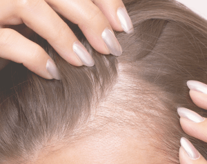 Chute_de_cheveux_ReGeneva_Banniere_300x238