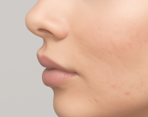 Cicatrices_et_teint_irregulier_ReGeneva-Banniere_300x238