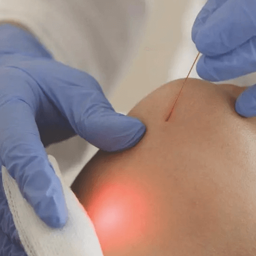 Endolift_ReGeneva_Banniere_Carree