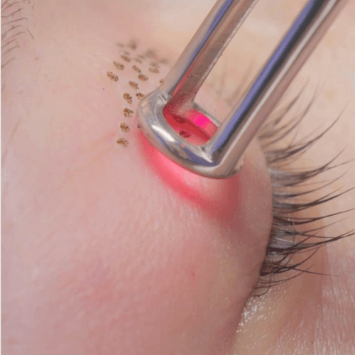 Laser_CO2_SilkPlex_ReGeneva_Banniere_Carree