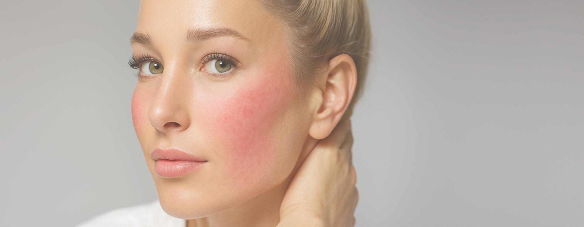 Rougeurs et rosacée