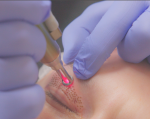 Blépharoplastie_médicale