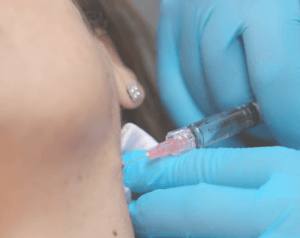 Injections_Profhilo_ReGeneva