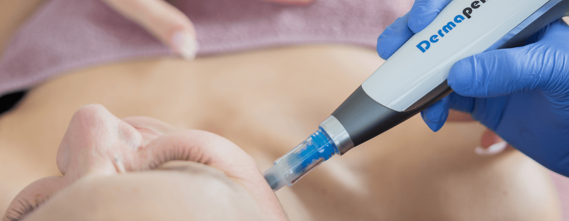 Microneedling à Genève