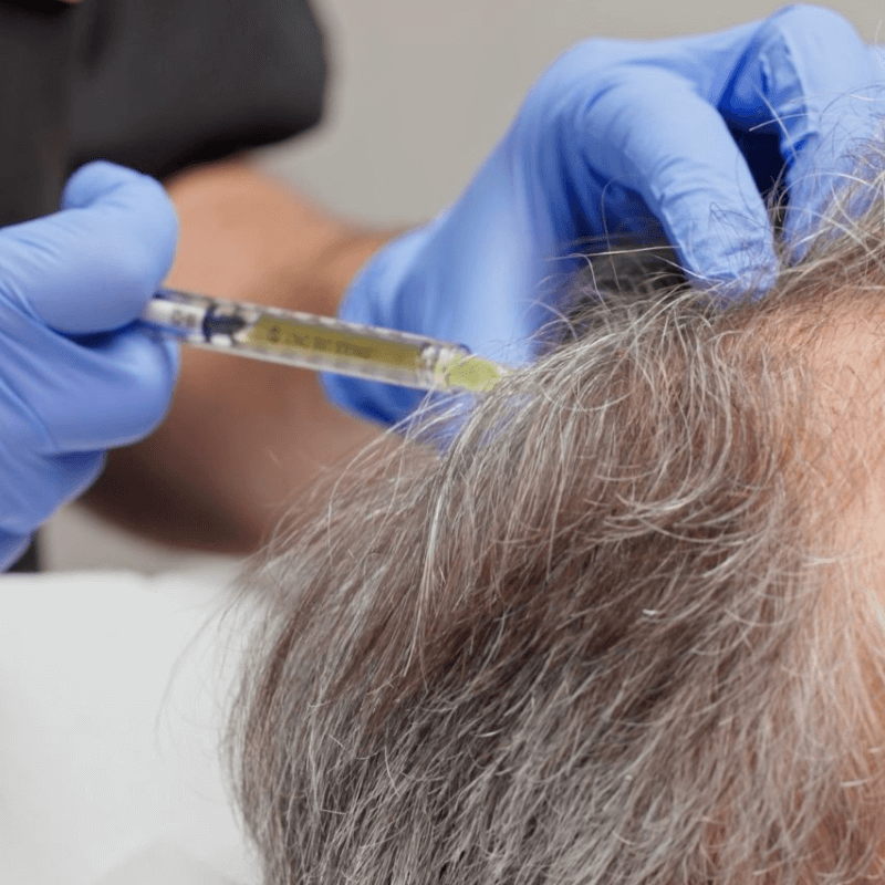PRP cheveux et cuir chevelu