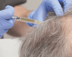 PRP_Cuir_Chevelu_ReGeneva(1)