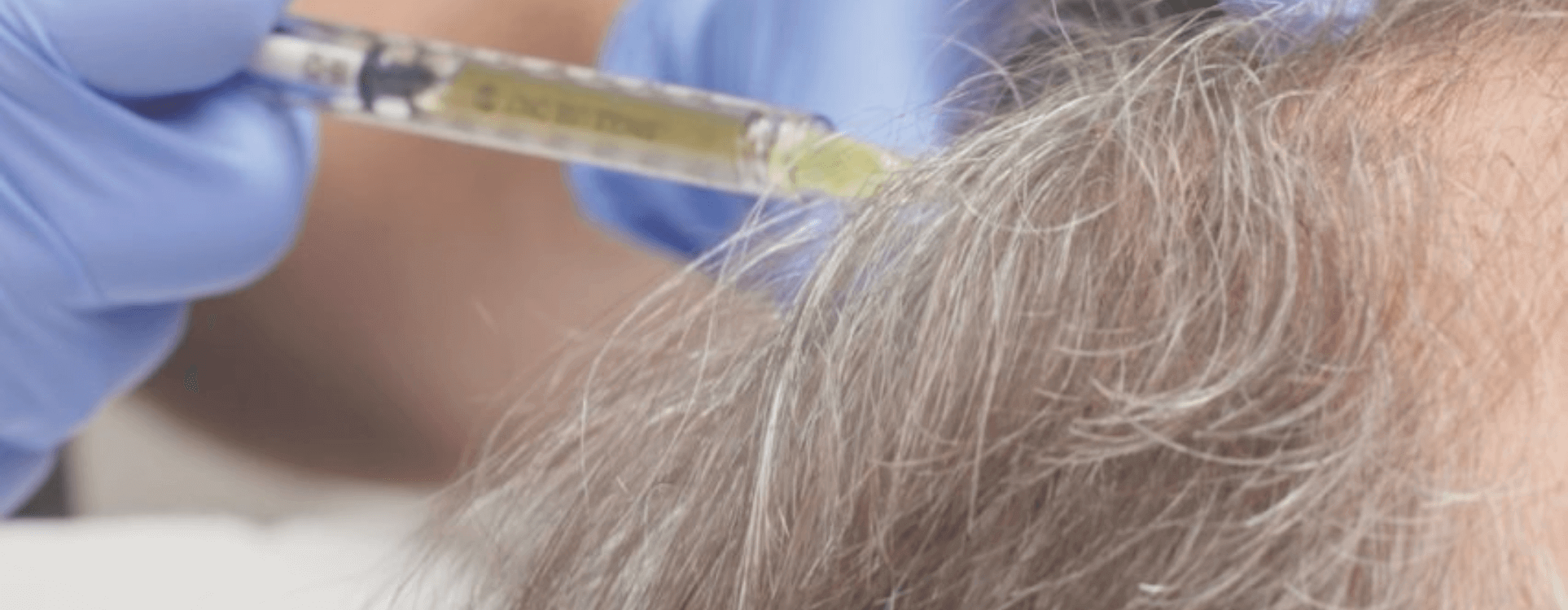 PRP Cheveux et Cuir chevelu