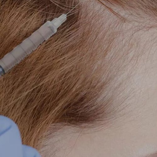 Mésothérapie cheveux et cuir chevelu Genève