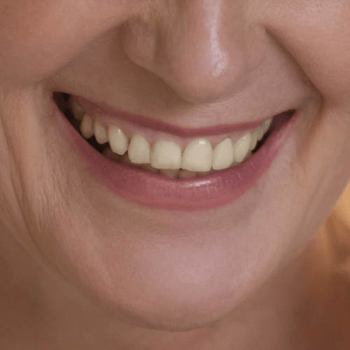 amélioration_de_la_peau_péribuccale-ReGeneva