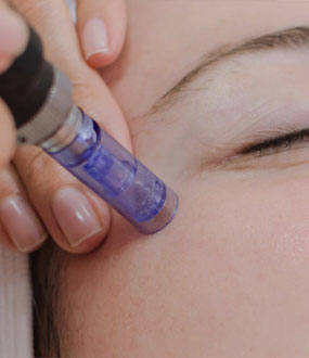 microneedling