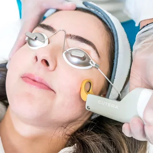 Laser-Cutera-Xeo