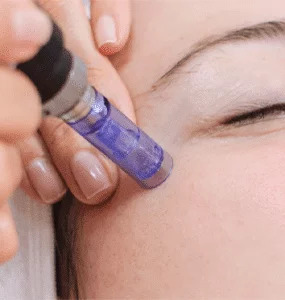 Microneedling