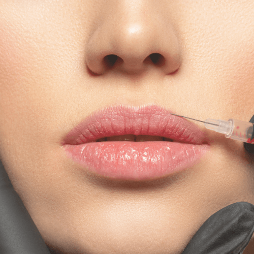 Injections des lèvres et du contour de bouche - ReGeneva (1)