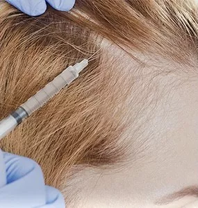 Mesotherapie cuir chevelu